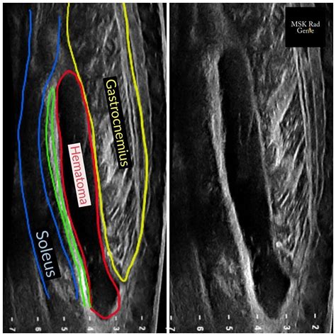 what test shows muscle tears|muscle strain vs tear imaging.